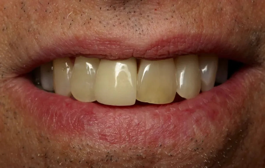 Before: a discolored upper front tooth.
